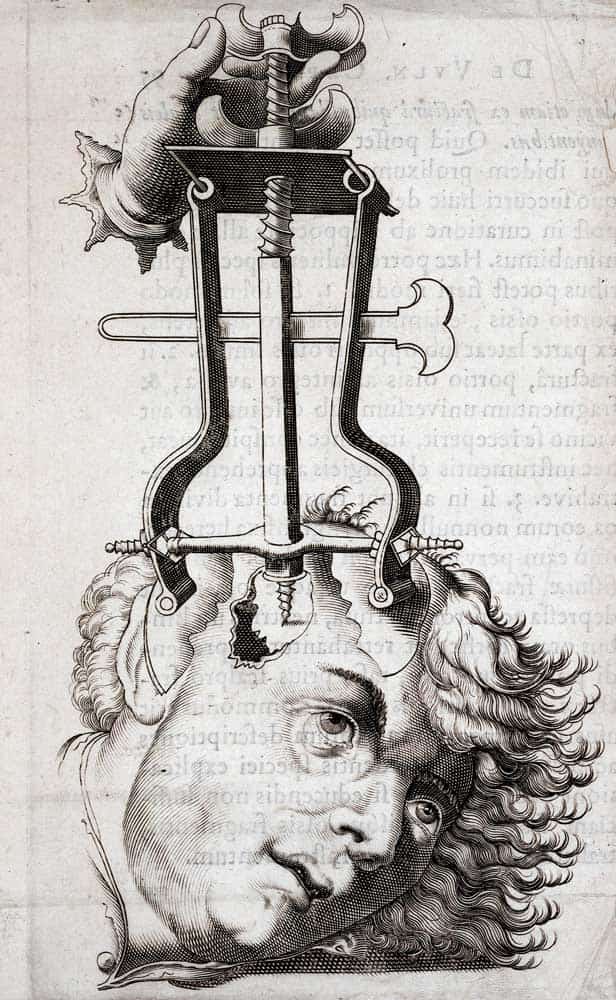 trepanation-celsus-surgery